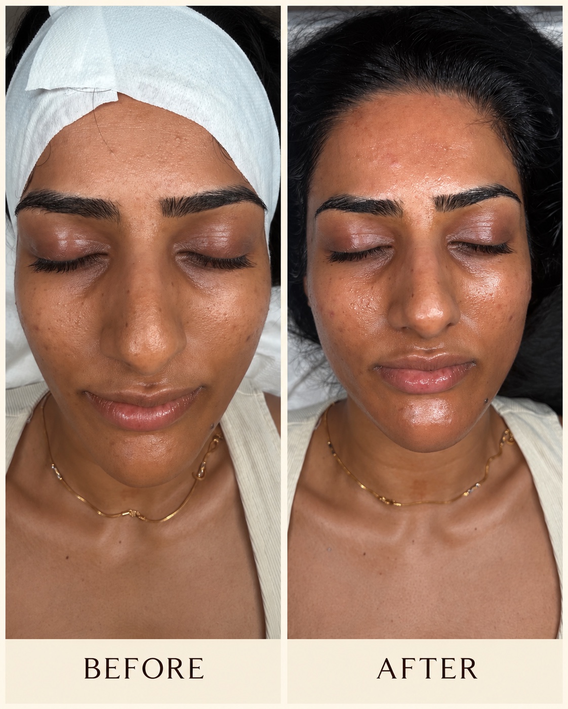 Before and after skin treatment comparison 1; before and after labels are included in the photo