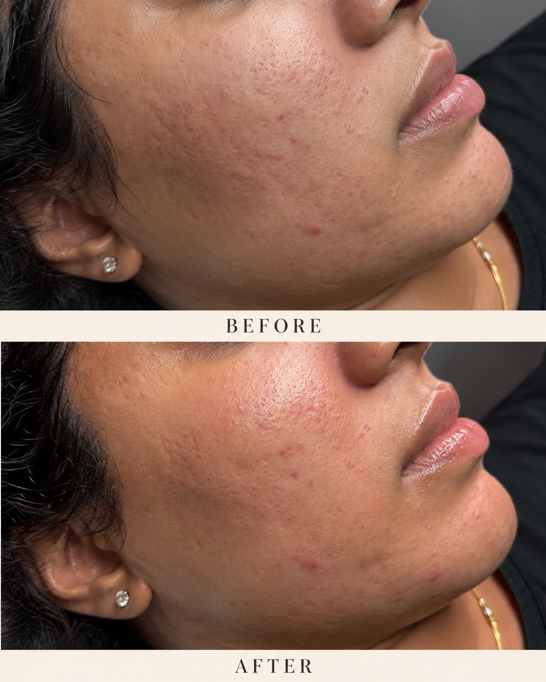 Before and after skin treatment comparison 2; before and after labels are included in the photo