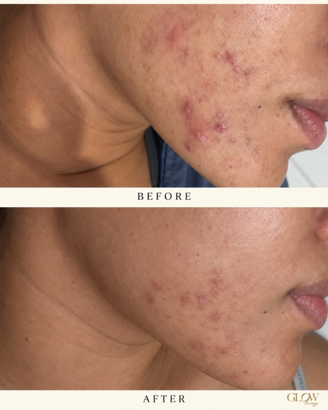 Before and after skin treatment comparison 3; before and after labels are included in the photo