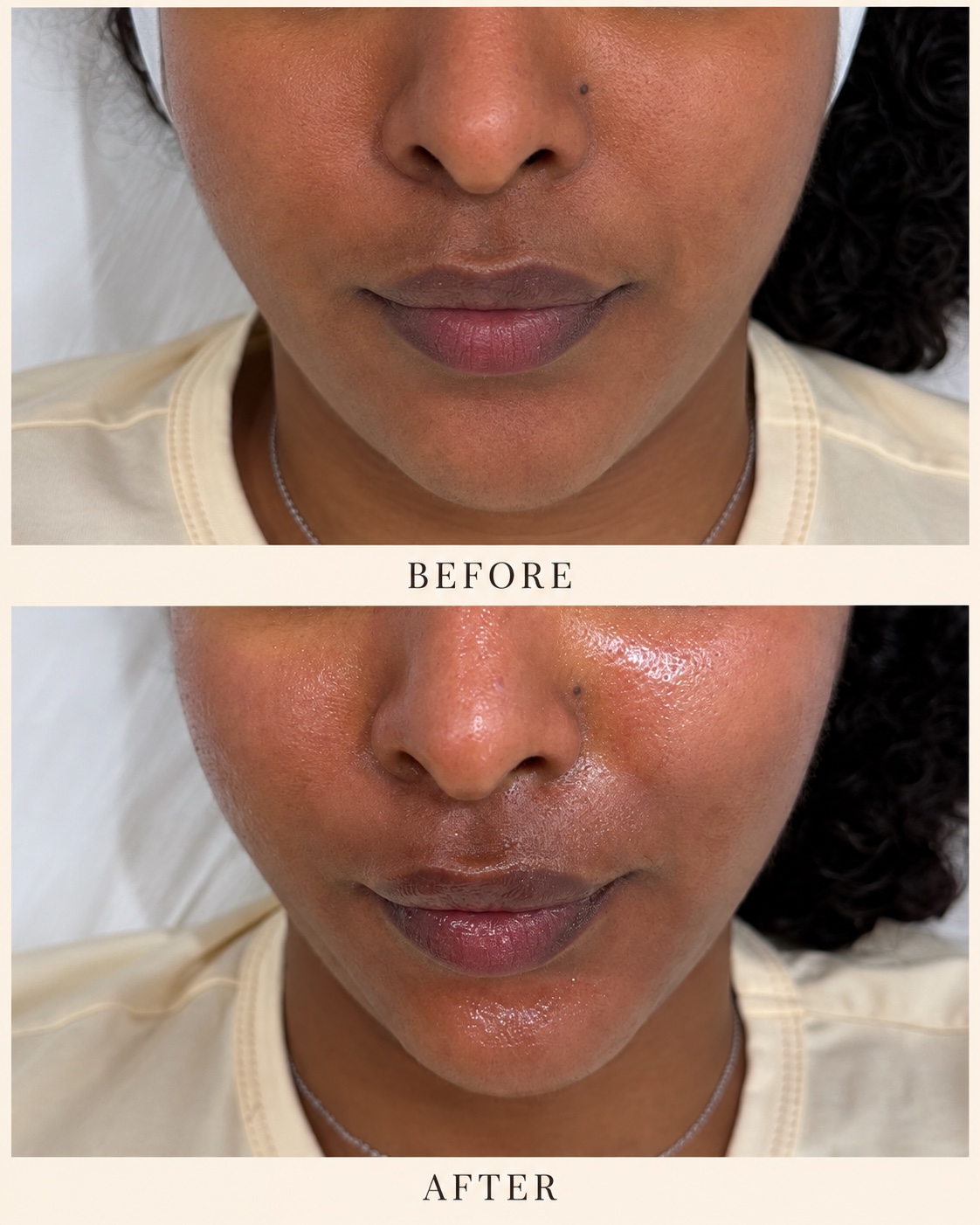 Before and after skin treatment comparison 4; before and after labels are included in the photo